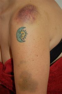 Agresiones contra Illy Nes