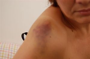 Agresiones contra Illy Nes